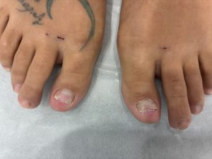 Fungal Nail Treatment con Láser Candela Nd:YA