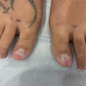 Fungal Nail Treatment con Láser Candela Nd:YA