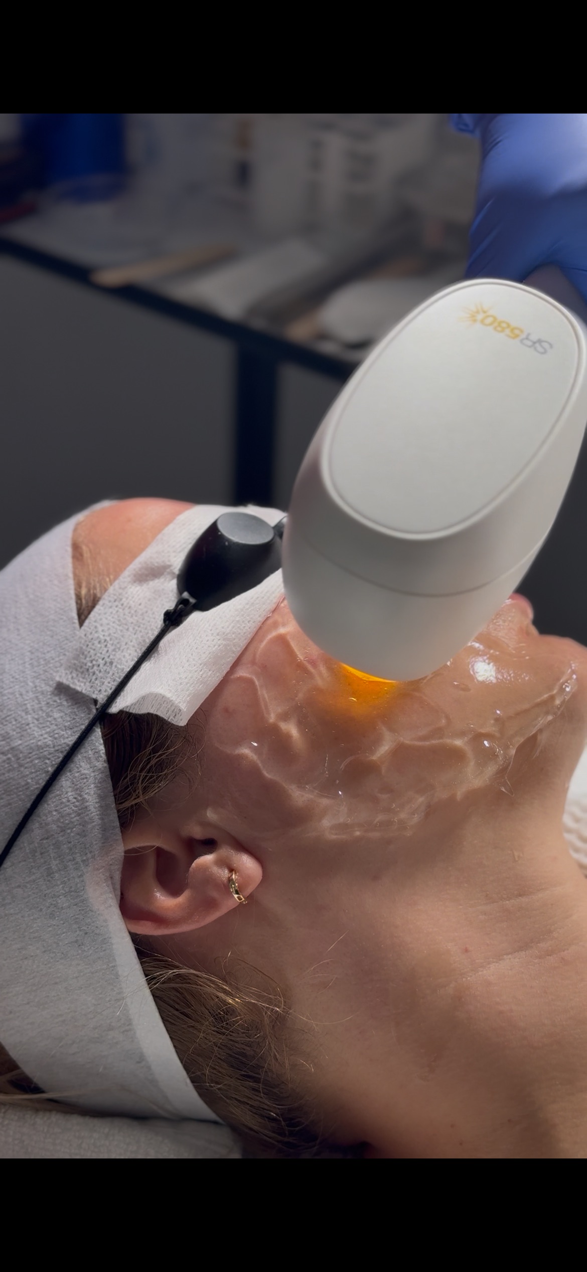 IPL (Intense Pulsed Light) con Venus Versa - Imagen 2