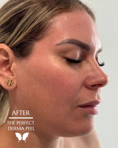 The Perfect Derma Peel
