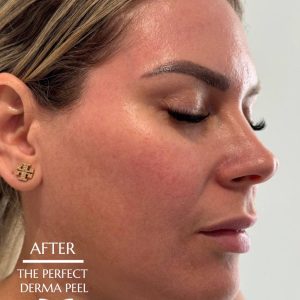 The Perfect Derma Peel