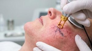 Spider Veins Treatment con Láser Candela Nd:YAG