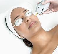Skin Tightening con Láser Nd:YAG Candela